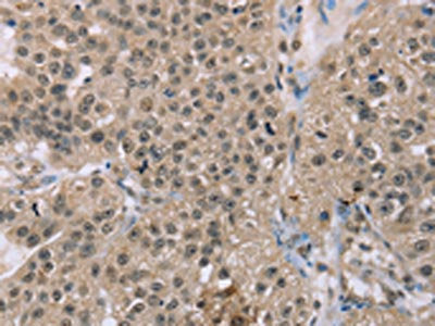 The image on the left is immunohistochemistry of paraffin-embedded Human breast cancer tissue using CSB-PA828857(ACTN2 Antibody) at dilution 1/30, on the right is treated with synthetic peptide. (Original magnification: ×200)