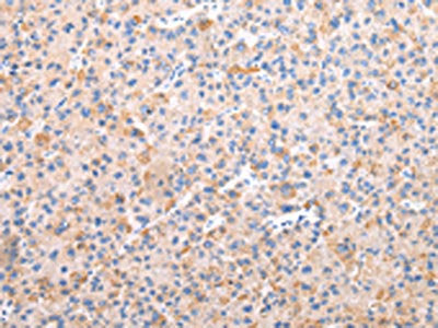 The image on the left is immunohistochemistry of paraffin-embedded Human liver cancer tissue using CSB-PA828936(AXIN1  Antibody) at dilution 1/30, on the right is treated with synthetic peptide. (Original magnification: ×200)