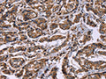 The image on the left is immunohistochemistry of paraffin-embedded Human breast cancer tissue using CSB-PA829093(HSPE1 Antibody) at dilution 1/40, on the right is treated with synthetic peptide. (Original magnification: ×200)