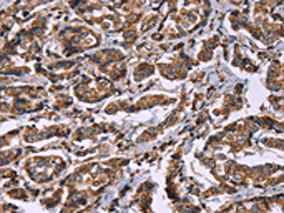 The image on the left is immunohistochemistry of paraffin-embedded Human breast cancer tissue using CSB-PA829093(HSPE1 Antibody) at dilution 1/40, on the right is treated with synthetic peptide. (Original magnification: ×200)