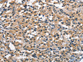 The image on the left is immunohistochemistry of paraffin-embedded Human thyroid cancer tissue using CSB-PA829218(ACPT Antibody) at dilution 1/30, on the right is treated with synthetic peptide. (Original magnification: ×200)