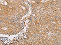 The image on the left is immunohistochemistry of paraffin-embedded Human lung cancer tissue using CSB-PA829328(PACSIN2 Antibody) at dilution 1/20, on the right is treated with fusion protein. (Original magnification: ×200)