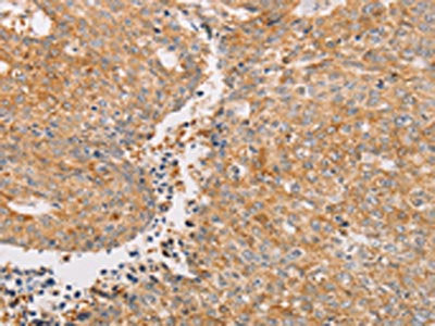 The image on the left is immunohistochemistry of paraffin-embedded Human lung cancer tissue using CSB-PA829328(PACSIN2 Antibody) at dilution 1/20, on the right is treated with fusion protein. (Original magnification: ×200)