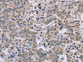 The image on the left is immunohistochemistry of paraffin-embedded Human liver cancer tissue using CSB-PA829370(EID1 Antibody) at dilution 1/40, on the right is treated with fusion protein. (Original magnification: ×200)