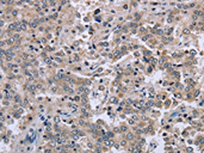 The image on the left is immunohistochemistry of paraffin-embedded Human liver cancer tissue using CSB-PA829370(EID1 Antibody) at dilution 1/40, on the right is treated with fusion protein. (Original magnification: ×200)