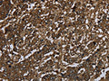The image on the left is immunohistochemistry of paraffin-embedded Human liver cancer tissue using CSB-PA829442(GLO1 Antibody) at dilution 1/60, on the right is treated with fusion protein. (Original magnification: ×200)