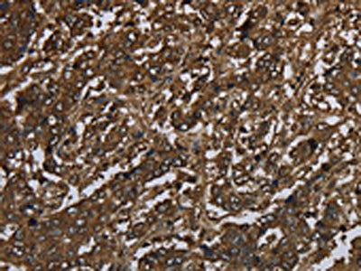 The image on the left is immunohistochemistry of paraffin-embedded Human liver cancer tissue using CSB-PA829442(GLO1 Antibody) at dilution 1/60, on the right is treated with fusion protein. (Original magnification: ×200)