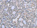The image on the left is immunohistochemistry of paraffin-embedded Human thyroid cancer tissue using CSB-PA829714(FES Antibody) at dilution 1/25, on the right is treated with fusion protein. (Original magnification: ×200)