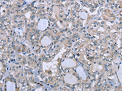 The image on the left is immunohistochemistry of paraffin-embedded Human thyroid cancer tissue using CSB-PA829714(FES Antibody) at dilution 1/25, on the right is treated with fusion protein. (Original magnification: ×200)