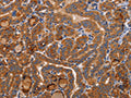 The image on the left is immunohistochemistry of paraffin-embedded Human thyroid cancer tissue using CSB-PA830149(BMP6 Antibody) at dilution 1/40, on the right is treated with synthetic peptide. (Original magnification: ×200)
