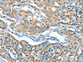 The image on the left is immunohistochemistry of paraffin-embedded Human lung cancer tissue using CSB-PA830209(SERPINA3 Antibody) at dilution 1/55, on the right is treated with fusion protein. (Original magnification: ×200)