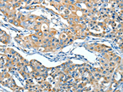 The image on the left is immunohistochemistry of paraffin-embedded Human lung cancer tissue using CSB-PA830209(SERPINA3 Antibody) at dilution 1/55, on the right is treated with fusion protein. (Original magnification: ×200)