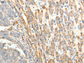 The image on the left is immunohistochemistry of paraffin-embedded Human liver cancer tissue using CSB-PA830383(BIRC2 Antibody) at dilution 1/20, on the right is treated with fusion protein. (Original magnification: ×200)