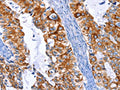 The image on the left is immunohistochemistry of paraffin-embedded Human cervical cancer tissue using CSB-PA830451(ARRB1 Antibody) at dilution 1/50, on the right is treated with fusion protein. (Original magnification: ×200)
