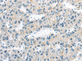 The image on the left is immunohistochemistry of paraffin-embedded Human liver cancer tissue using CSB-PA830584(VLDLR Antibody) at dilution 1/40, on the right is treated with synthetic peptide. (Original magnification: ×200)