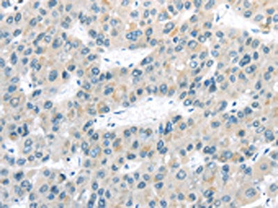 The image on the left is immunohistochemistry of paraffin-embedded Human liver cancer tissue using CSB-PA830584(VLDLR Antibody) at dilution 1/40, on the right is treated with synthetic peptide. (Original magnification: ×200)