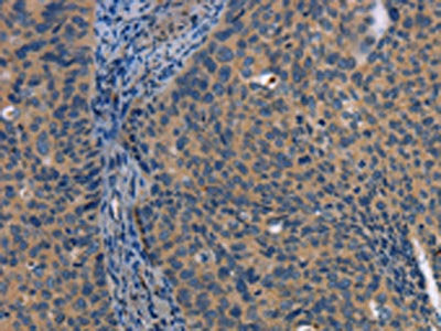 The image on the left is immunohistochemistry of paraffin-embedded Human cervical cancer tissue using CSB-PA830665(LATS1 Antibody) at dilution 1/25, on the right is treated with fusion protein. (Original magnification: ×200)