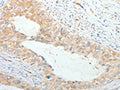 The image on the left is immunohistochemistry of paraffin-embedded Human cervical cancer tissue using CSB-PA830841(PRPH Antibody) at dilution 1/20, on the right is treated with fusion protein. (Original magnification: ×200)