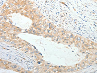 The image on the left is immunohistochemistry of paraffin-embedded Human cervical cancer tissue using CSB-PA830841(PRPH Antibody) at dilution 1/20, on the right is treated with fusion protein. (Original magnification: ×200)
