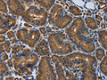 The image is immunohistochemistry of paraffin-embedded Human thyroid cancer tissue using CSB-PA830872(SNCG Antibody) at dilution 1/50. (Original magnification: ×200)