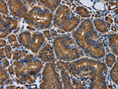 The image is immunohistochemistry of paraffin-embedded Human thyroid cancer tissue using CSB-PA830872(SNCG Antibody) at dilution 1/50. (Original magnification: ×200)