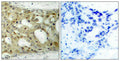 Immunohistochemical analysis of paraffin-embedded human breast carcinoma tissue using Androgen Receptor (Phospho-Ser650) Antibody (left) or the same antibody preincubated with blocking peptide (right).