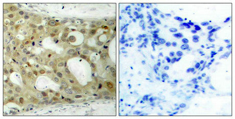 Immunohistochemical analysis of paraffin-embedded human breast carcinoma tissue using Androgen Receptor (Phospho-Ser650) Antibody (left) or the same antibody preincubated with blocking peptide (right).