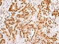 The image on the left is immunohistochemistry of paraffin-embedded Human colon cancer tissue using CSB-PA831298(TAX1BP1 Antibody) at dilution 1/60, on the right is treated with fusion protein. (Original magnification: ×200)