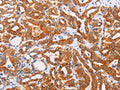 The image on the left is immunohistochemistry of paraffin-embedded Human thyroid cancer tissue using CSB-PA831487(SYVN1 Antibody) at dilution 1/10, on the right is treated with fusion protein. (Original magnification: ×200)
