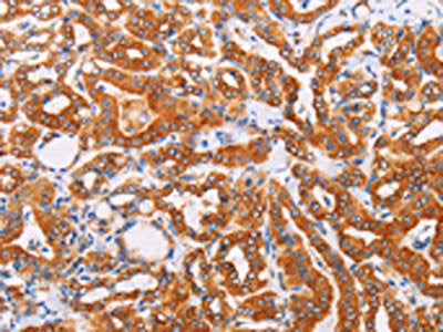 The image on the left is immunohistochemistry of paraffin-embedded Human thyroid cancer tissue using CSB-PA831487(SYVN1 Antibody) at dilution 1/10, on the right is treated with fusion protein. (Original magnification: ×200)