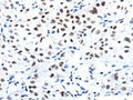 The image on the left is immunohistochemistry of paraffin-embedded Human lung cancer tissue using CSB-PA831688(CBX8 Antibody) at dilution 1/10, on the right is treated with fusion protein. (Original magnification: ×200)