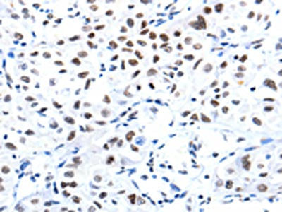The image on the left is immunohistochemistry of paraffin-embedded Human lung cancer tissue using CSB-PA831688(CBX8 Antibody) at dilution 1/10, on the right is treated with fusion protein. (Original magnification: ×200)