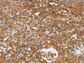 The image on the left is immunohistochemistry of paraffin-embedded Human cervical cancer tissue using CSB-PA831796(CRELD2 Antibody) at dilution 1/40, on the right is treated with fusion protein. (Original magnification: ×200)