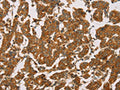 The image on the left is immunohistochemistry of paraffin-embedded Human breast cancer tissue using CSB-PA831848(DLL4 Antibody) at dilution 1/50, on the right is treated with fusion protein. (Original magnification: ×200)