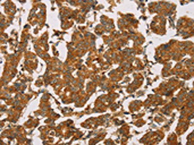 The image on the left is immunohistochemistry of paraffin-embedded Human breast cancer tissue using CSB-PA831848(DLL4 Antibody) at dilution 1/50, on the right is treated with fusion protein. (Original magnification: ×200)