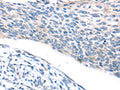 The image on the left is immunohistochemistry of paraffin-embedded Human esophagus cancer tissue using CSB-PA831980(ADRB3 Antibody) at dilution 1/25, on the right is treated with synthetic peptide. (Original magnification: ×200)