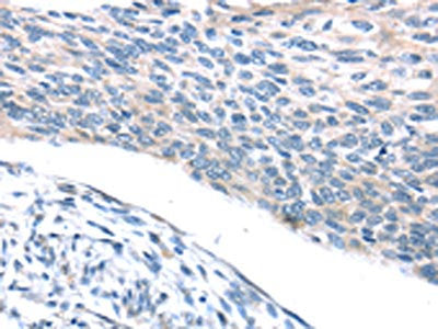 The image on the left is immunohistochemistry of paraffin-embedded Human esophagus cancer tissue using CSB-PA831980(ADRB3 Antibody) at dilution 1/25, on the right is treated with synthetic peptide. (Original magnification: ×200)