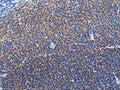 The image on the left is immunohistochemistry of paraffin-embedded Human lymphoma tissue using CSB-PA832352(SYK Antibody) at dilution 1/20, on the right is treated with fusion protein. (Original magnification: ×200)