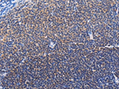 The image on the left is immunohistochemistry of paraffin-embedded Human lymphoma tissue using CSB-PA832352(SYK Antibody) at dilution 1/20, on the right is treated with fusion protein. (Original magnification: ×200)