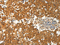 The image on the left is immunohistochemistry of paraffin-embedded Human breast cancer tissue using CSB-PA832569(PTPRE Antibody) at dilution 1/10, on the right is treated with fusion protein. (Original magnification: ×200)