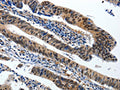 The image on the left is immunohistochemistry of paraffin-embedded Human colorectal cancer tissue using CSB-PA832691(BCL2 Antibody) at dilution 1/20, on the right is treated with synthetic peptide. (Original magnification: ×200)