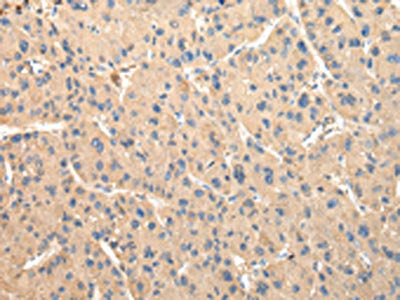 The image on the left is immunohistochemistry of paraffin-embedded Human liver cancer tissue using CSB-PA833161(DUSP11 Antibody) at dilution 1/50, on the right is treated with fusion protein. (Original magnification: ×200)