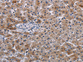 The image on the left is immunohistochemistry of paraffin-embedded Human lung cancer tissue using CSB-PA833279(JAKMIP2 Antibody) at dilution 1/30, on the right is treated with fusion protein. (Original magnification: ×200)