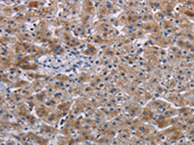 The image on the left is immunohistochemistry of paraffin-embedded Human lung cancer tissue using CSB-PA833279(JAKMIP2 Antibody) at dilution 1/30, on the right is treated with fusion protein. (Original magnification: ×200)