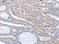 The image on the left is immunohistochemistry of paraffin-embedded Human thyroid cancer tissue using CSB-PA834137(TIMP3 Antibody) at dilution 1/20, on the right is treated with fusion protein. (Original magnification: ×200)