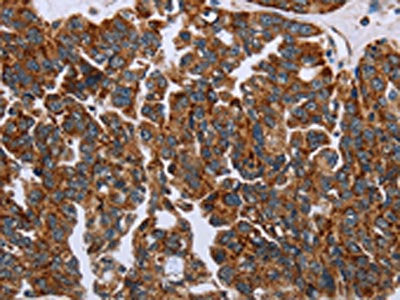 The image on the left is immunohistochemistry of paraffin-embedded Human ovarian cancer tissue using CSB-PA834150(HSD3B2 Antibody) at dilution 1/20, on the right is treated with fusion protein. (Original magnification: ×200)