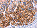 The image on the left is immunohistochemistry of paraffin-embedded Human liver cancer tissue using CSB-PA834531(AADAC Antibody) at dilution 1/30, on the right is treated with fusion protein. (Original magnification: ×200)