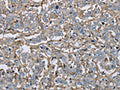 The image on the left is immunohistochemistry of paraffin-embedded Human liver cancer tissue using CSB-PA834684(FCGR2B Antibody) at dilution 1/40, on the right is treated with fusion protein. (Original magnification: ×200)
