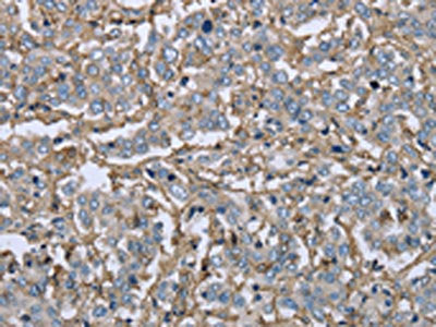 The image on the left is immunohistochemistry of paraffin-embedded Human liver cancer tissue using CSB-PA834684(FCGR2B Antibody) at dilution 1/40, on the right is treated with fusion protein. (Original magnification: ×200)