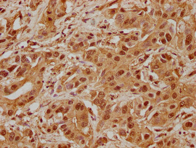 IHC image of CSB-PA836229NA01HU diluted at 1:100 and staining in paraffin-embedded human liver cancer performed on a Leica BondTM system. After dewaxing and hydration, antigen retrieval was mediated by high pressure in a citrate buffer (pH 6.0). Section was blocked with 10% normal goat serum 30min at RT. Then primary antibody (1% BSA) was incubated at 4°C overnight. The primary is detected by a biotinylated secondary antibody and visualized using an HRP conjugated SP system.